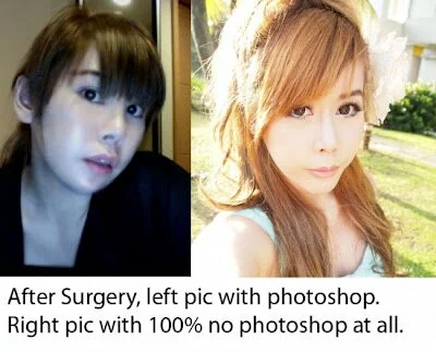 Eyelid Plastic Surgery on Jacqueline Koh Before And After Plastic Surgery